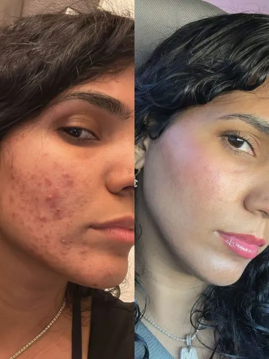 Acne Clear, BHEAL client result