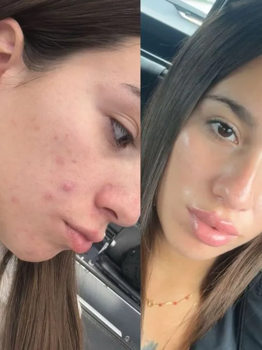 Post-acne, BHEAL client result